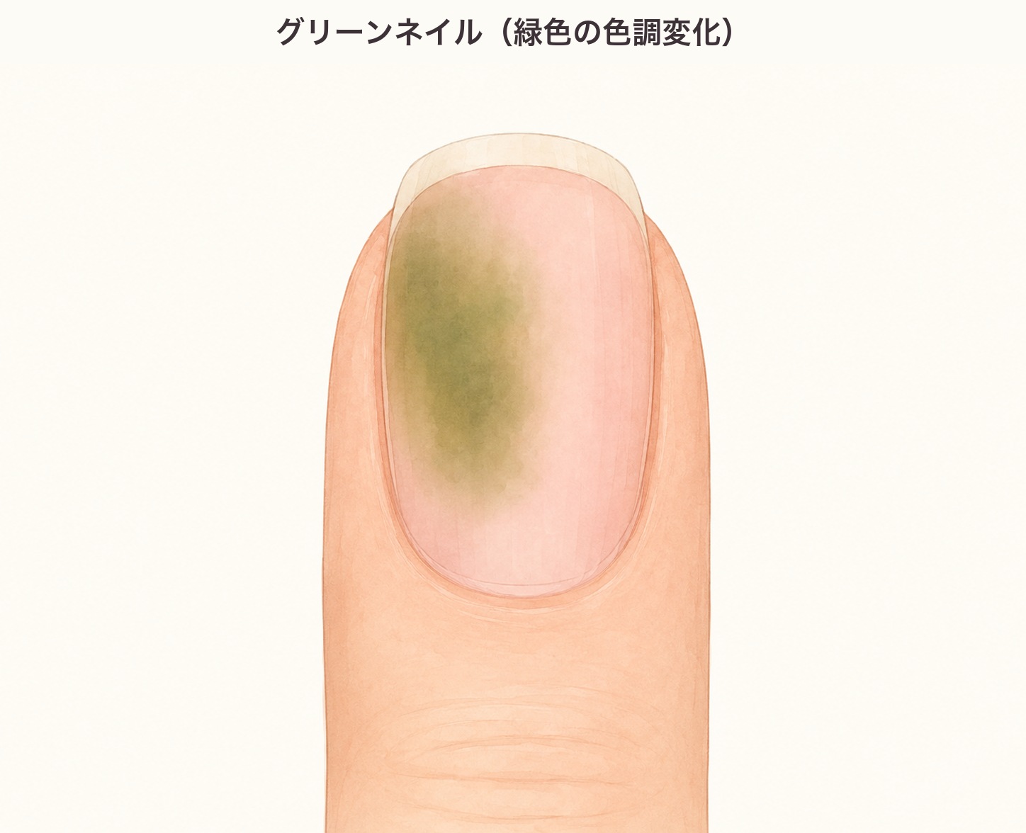 緑色に変色した爪の図。緑膿菌感染(グリーンネイル)による不規則な緑色の色ムラ