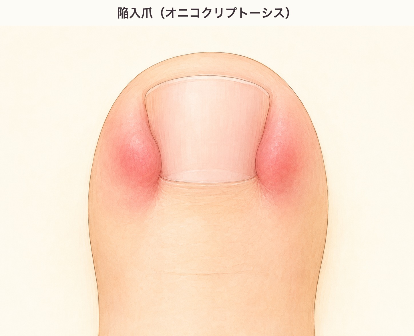 陥入爪（オニコクリプトーシス）の図。爪の左右の皮膚が赤く腫れている状態